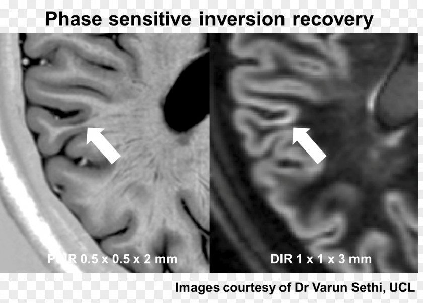 Graymatter Multiple Sclerosis Magnetic Resonance Imaging Depression Cognitive Disorder Disease PNG