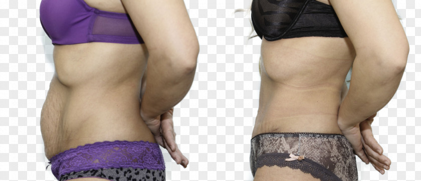 Abdominal Waist Abdominoplasty Abdomen Hip Underpants PNG