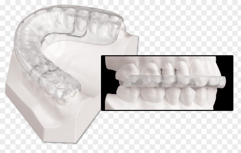 Mandibular Advancement Splint Dentistry Jaw Temporomandibular Joint Dysfunction PNG