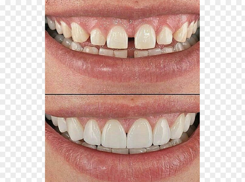 Crown Tooth Veneer Dentistry Farza Optical PNG