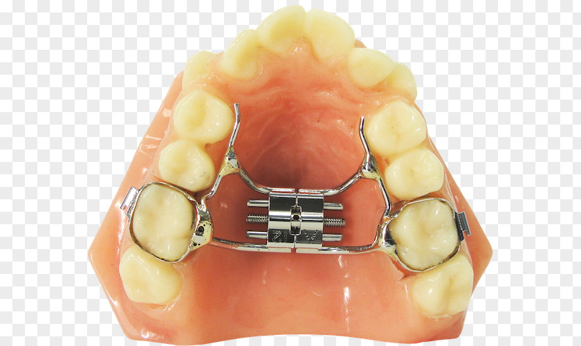 Tooth Orthodontic Technology Orthodontics Dentistry Dental Braces PNG