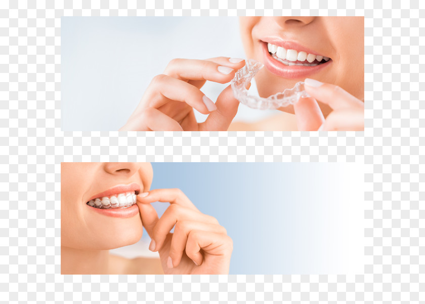 Department Clear Aligners Dentistry Orthodontics Dental Braces The Invisalign System PNG