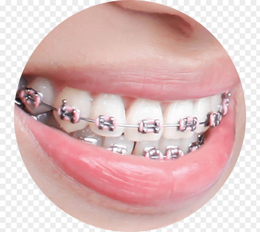 Orthodontics Surgery Dental Braces Dentistry Human Tooth PNG