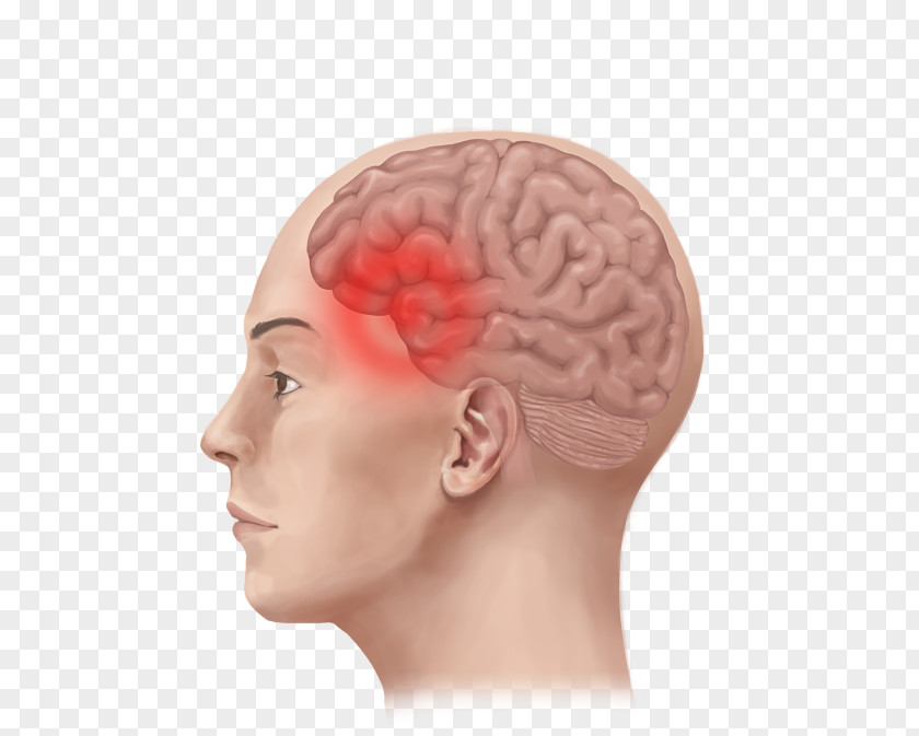 Ear Migraine Tension Headache Therapy PNG