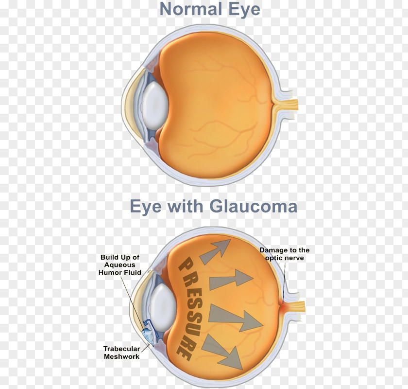 Eye Glaucoma Human Care Professional Optic Nerve PNG