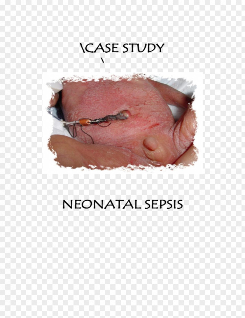 Neonatal Sepsis Infant Neonatology Preterm Birth PNG