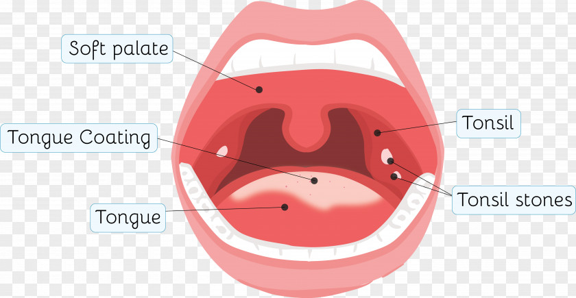 Sore Throat Tonsillolith Tonsillitis Health PNG