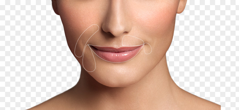Lip Augmentation Restylane Wrinkle Botulinum Toxin PNG