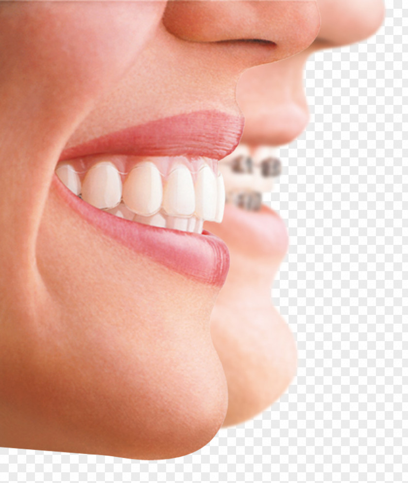 Crown Clear Aligners Dental Braces Orthodontics Veneer Dentistry PNG