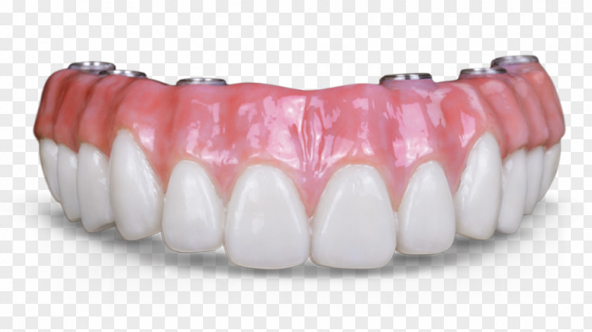 Bridge Dental Implant Dentures Dentistry Prosthesis Fixed Prosthodontics PNG