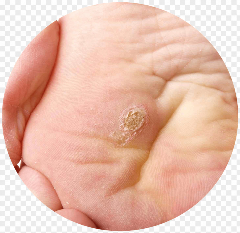 Corn Plantar Wart Callus Foot Dermatology PNG