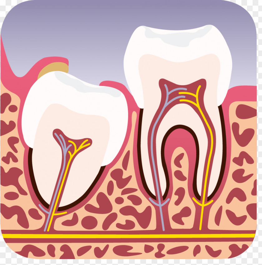 Wisdom Tooth Horten Tannlegesenter DA Dental Extraction Dentist PNG