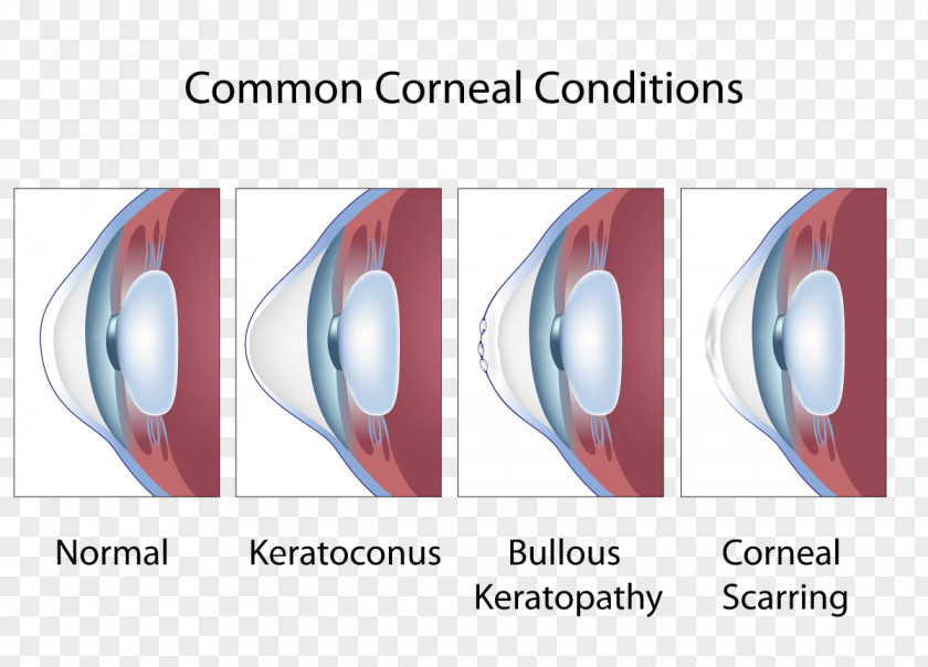 Eye Keratoconus Cornea Symptom Ophthalmology PNG
