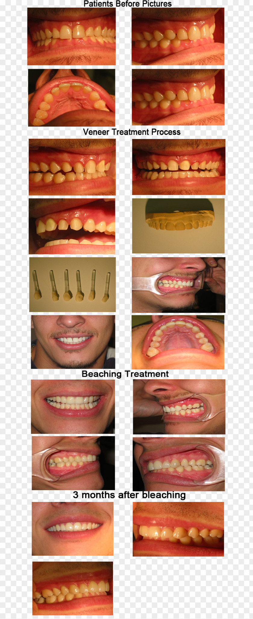 Veneers Veneer Dentistry Dental Porcelain Tooth PNG