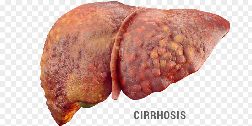 Health Liver Disease Hepatic Encephalopathy Fatty Hepatitis PNG