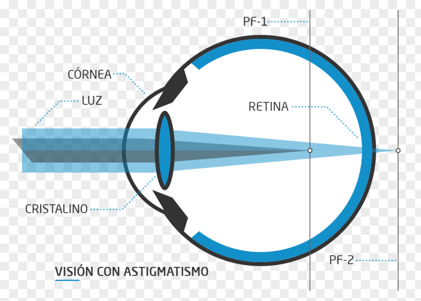 Eye Floater Nd:YAG Laser Visual Perception Presbyopia PNG