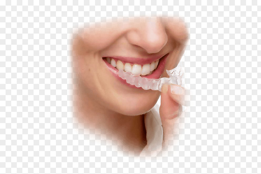 Clear Aligners Orthodontics Dental Braces Dentistry PNG