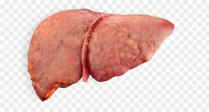 Liver Image Alcoholic Disease Cirrhosis Fatty PNG