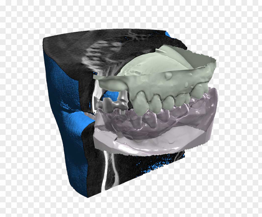 Dicom CAD/CAM Dentistry DICOM Computer Software Abutment Computer-aided Design PNG