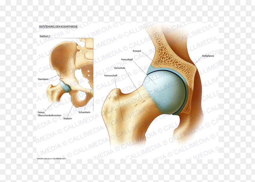 Ráº¯n 3d Hip Rheumatoid Arthritis Therapy Femur PNG