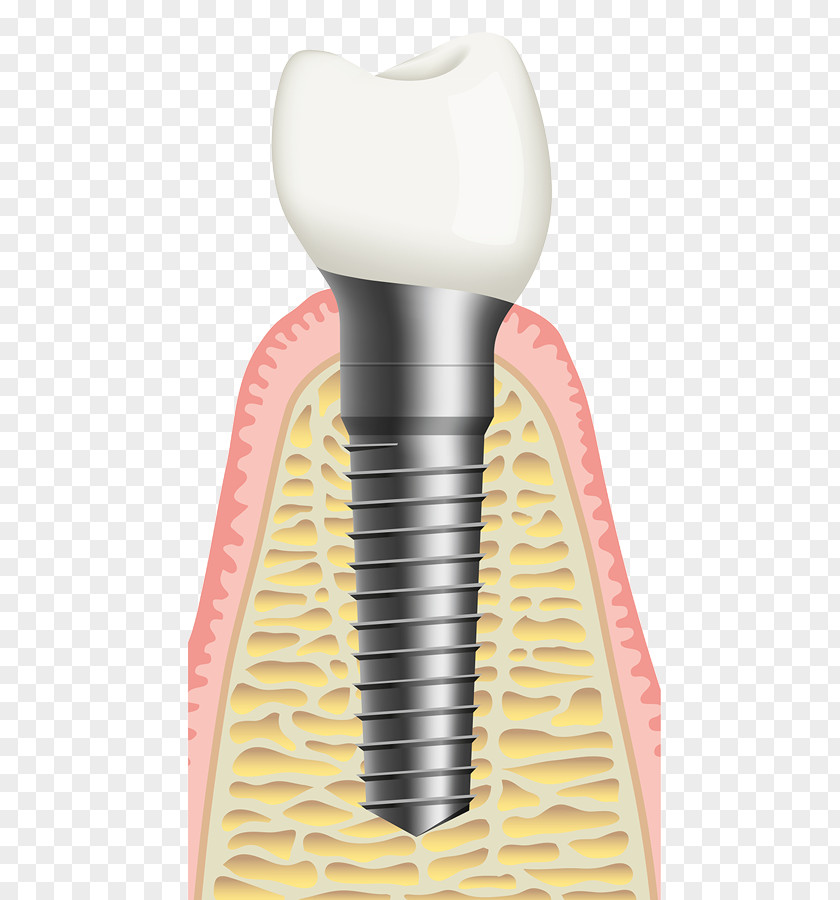 Implants Bone Grafting Dental Implant Sinus Lift Dentist PNG