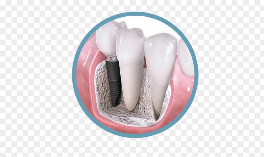 Crown Dental Implant Dentistry Surgery PNG