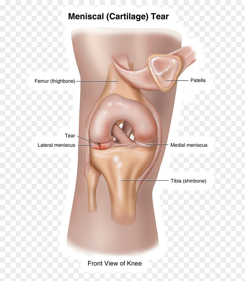 Knee Pain Meniscus Joint Ruptur PNG