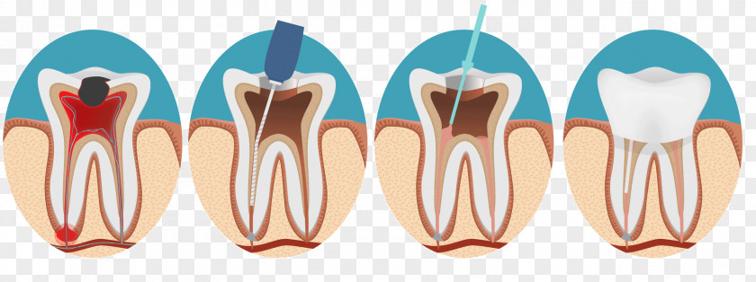 Dentistry Endodontic Therapy Root Canal Endodontics PNG