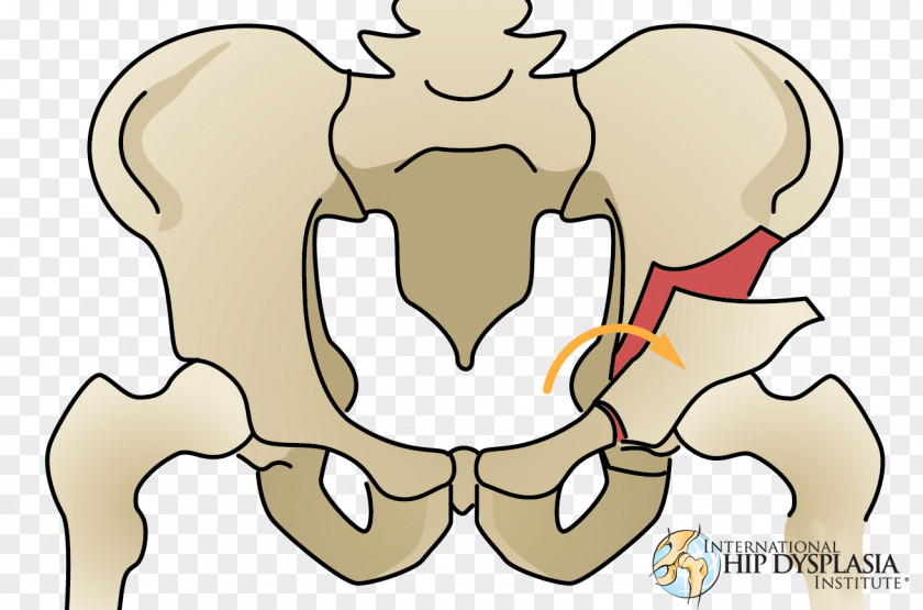 Bones Osteotomy Hip Dysplasia Acetabulum Femur PNG