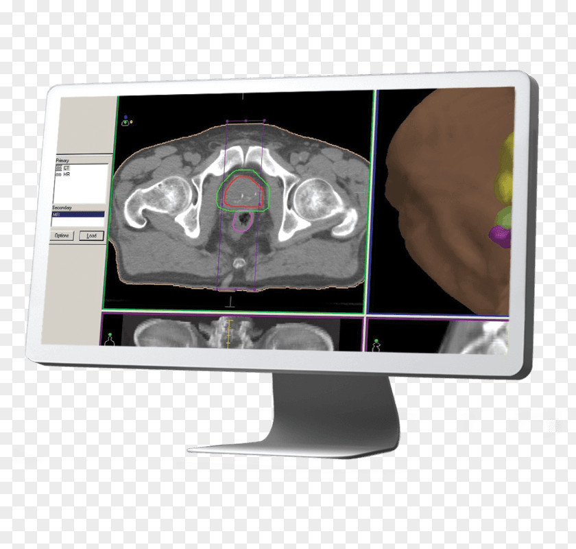 Particle Spot Elekta Xiotech Computer Monitors Radiation Therapy PNG