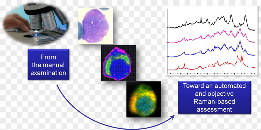 Acute Lymphoblastic Leukemia Surface-enhanced Raman Spectroscopy Cancer Cell PNG