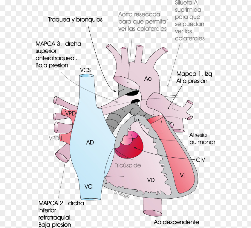 Pulmonary Atresia Ventricular Septal Defect Artery Aorta PNG