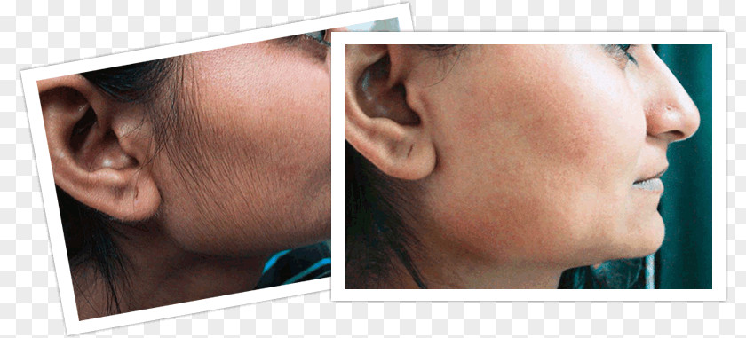 Before And After Hair Removal Facial Woman PNG