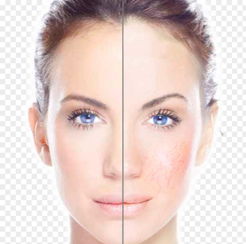 Cosmetic Vein Laser Center Freckle Hair Removal Hyperpigmentation PNG