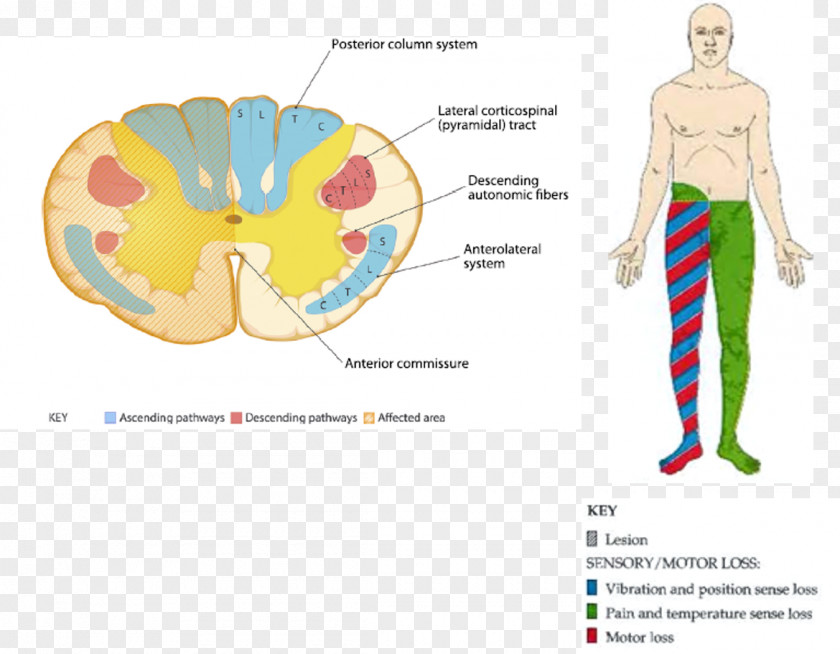 Brain Central Cord Syndrome Spinal Injury Upper Motor Neuron PNG