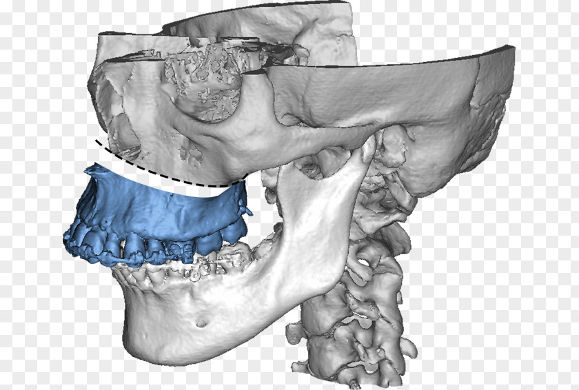 Head Man Maxilla Jaw Dysgnathie Bimaxillär Mandible PNG