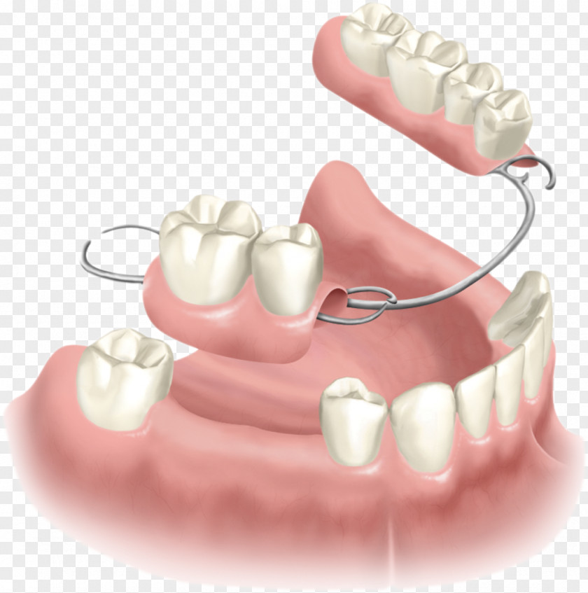 Implant Tooth Removable Partial Denture Dentures Dental Dentistry PNG