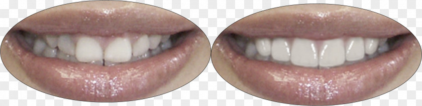 Crown Lengthening Veneer Dentistry Mouth PNG