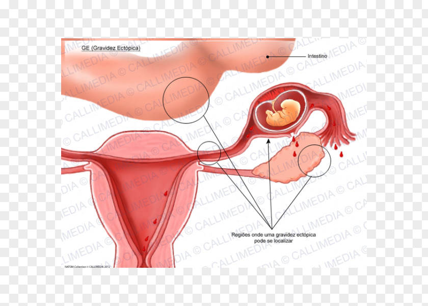 Pregnancy Ectopic Uterus Gynaecology Symptom PNG