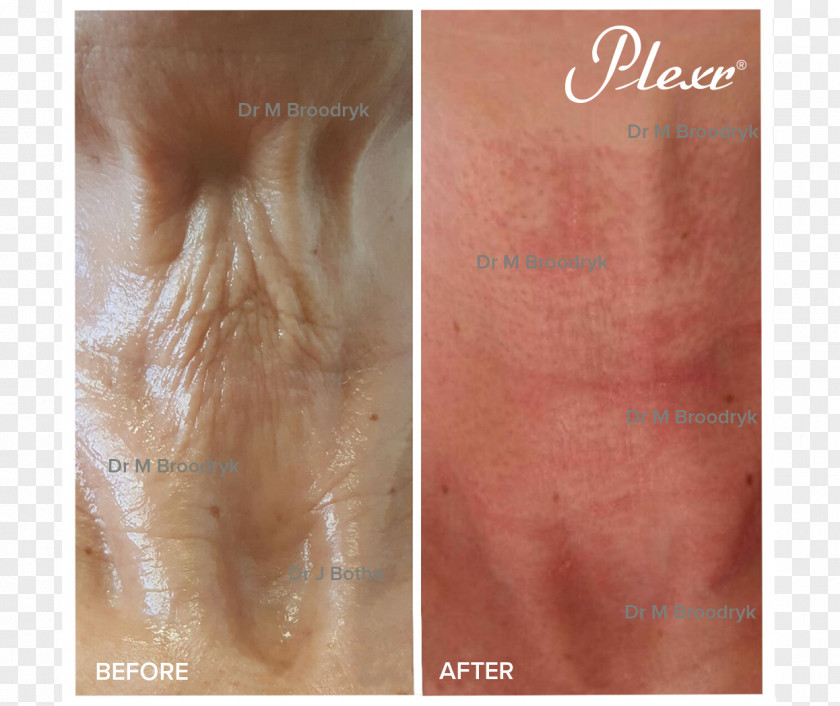 BEFORE AFTER Neck Wrinkle Skin Therapy Shingles PNG