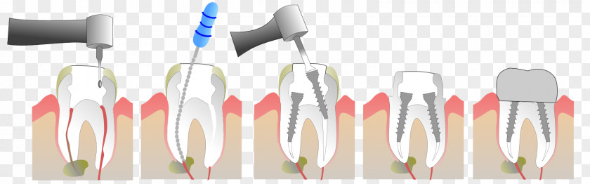 Une Dent Root Canal Endodontic Therapy Crown Tooth Dentist PNG