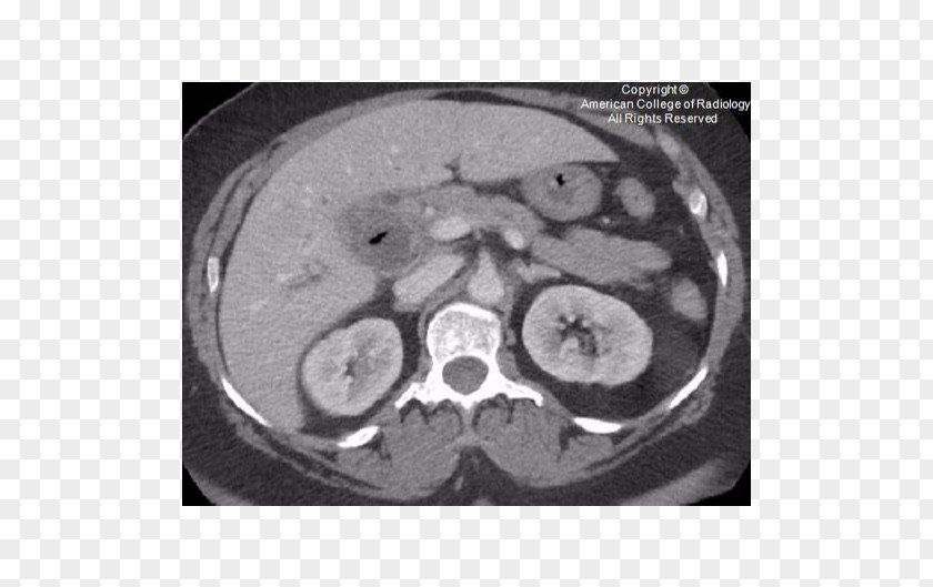 Fistula Computed Tomography Bone Organism PNG