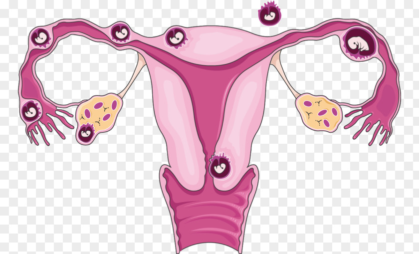 Ectopic Pregnancy Uterus Tubal Ligation Ultrasonography PNG
