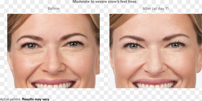 Hyaluronic Acid Botulinum Toxin Wrinkle Frown Forehead Injectable Filler PNG