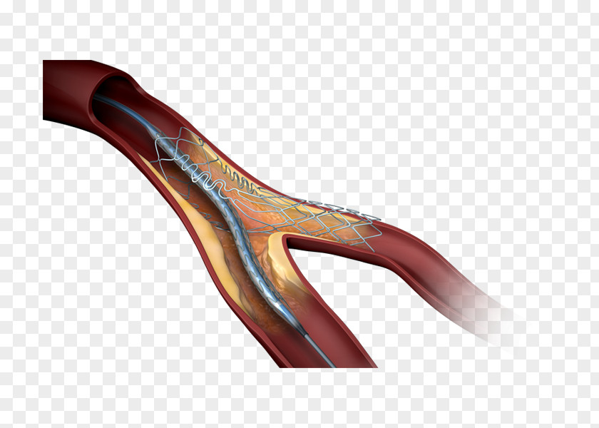 Heart Stenting Drug-eluting Stent Coronary Artery Disease Bare-metal PNG