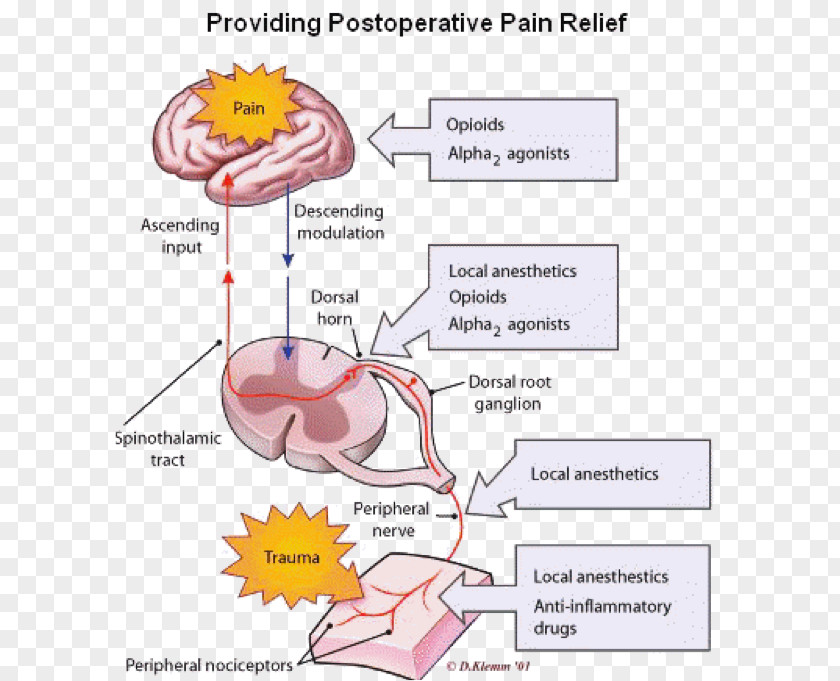 Anesthesiology Acute Pain Management Chronic Analgesic PNG