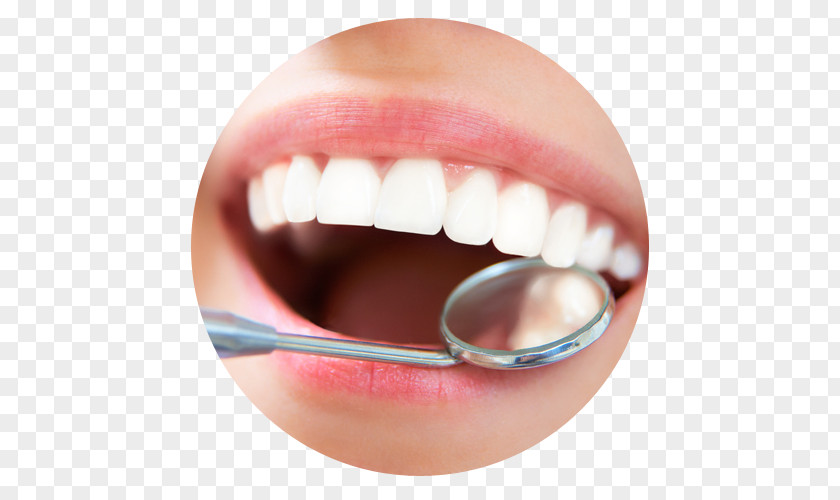 Health Dentistry Scaling And Root Planing Dental Implant Teeth Cleaning PNG