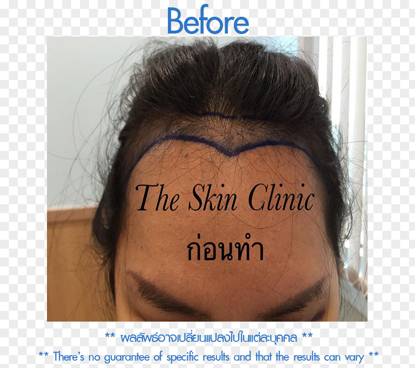 Mupai Follicular Unit Extraction Eyebrow Forehead Cheek Nose PNG