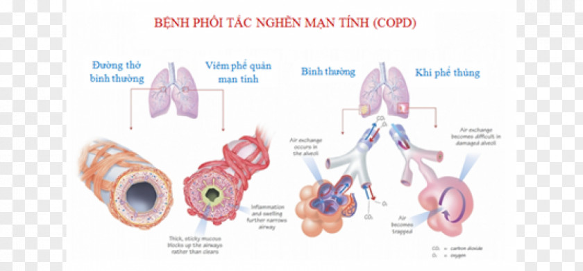 Chronic Disease Regenerative Medicine Stem Cell Obstructive Pulmonary Stem-cell Therapy PNG