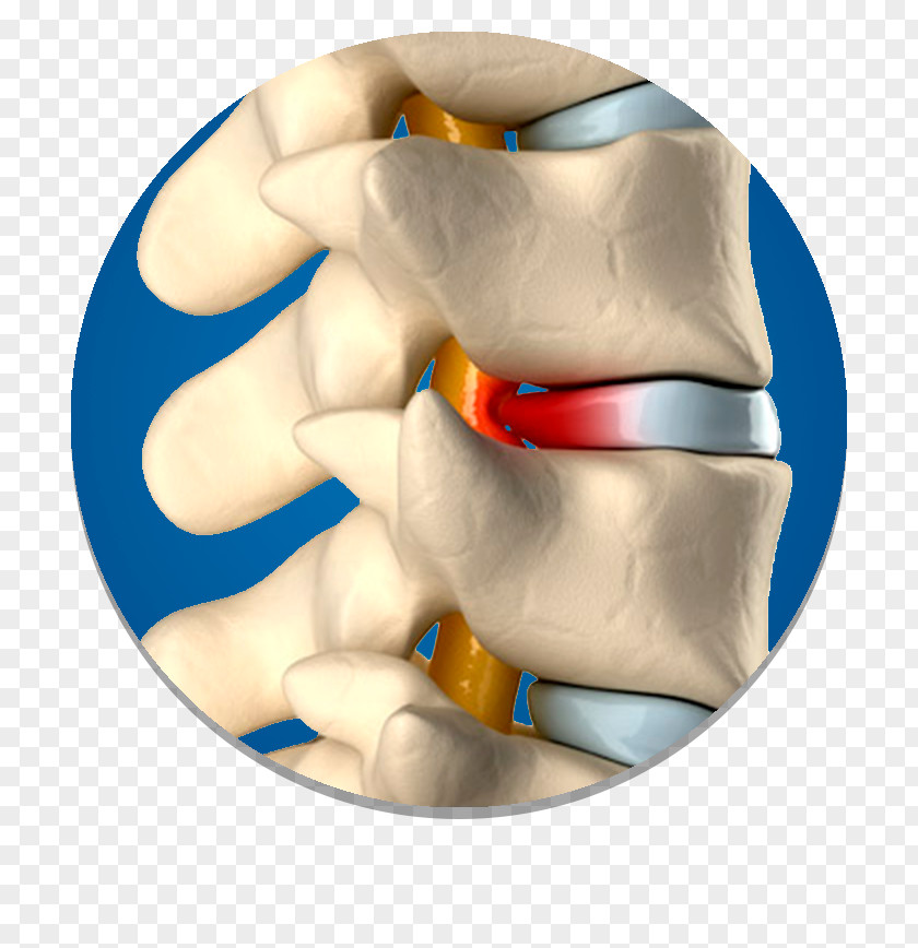 Spinal Disc Herniation Vertebral Column Surgery Intervertebral PNG